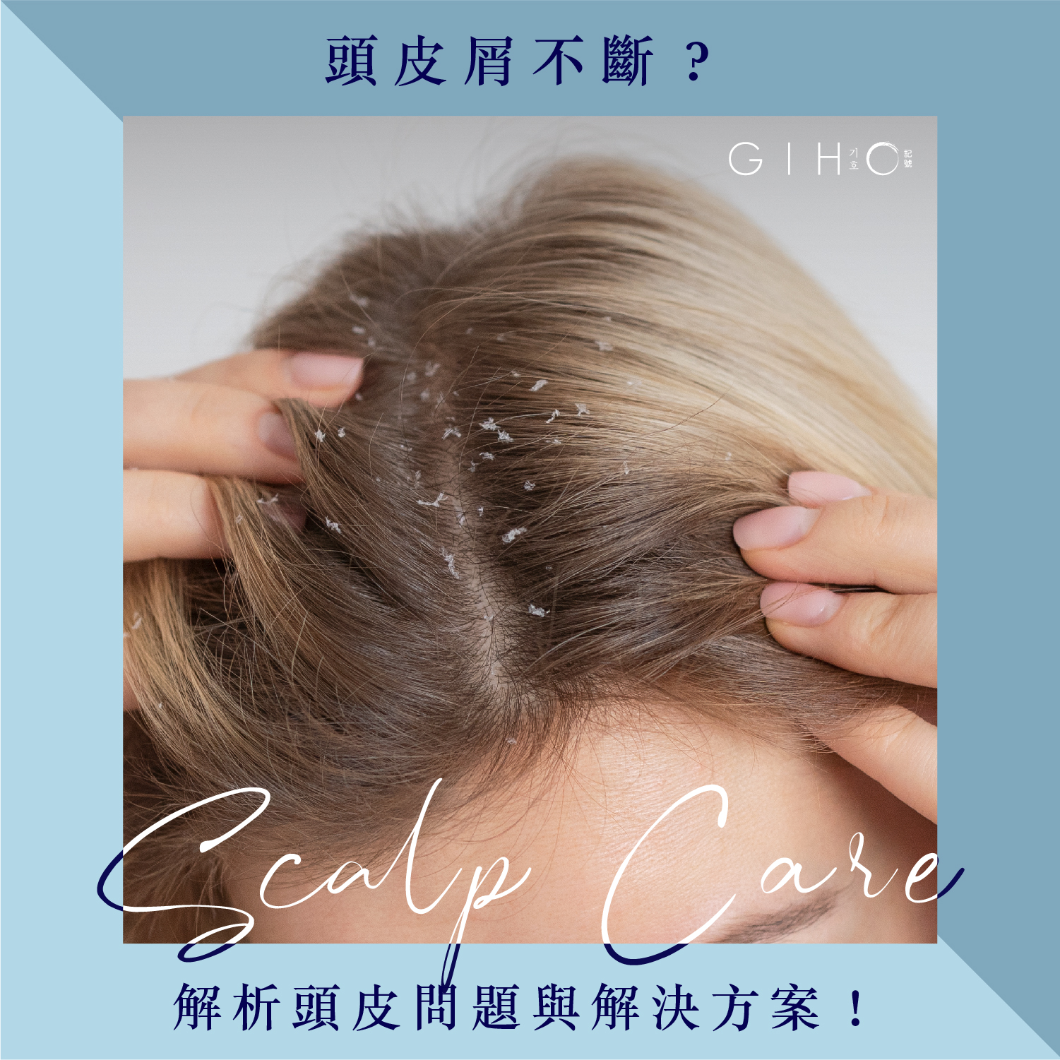 頭皮屑不斷？解析頭皮問題與解決方案！